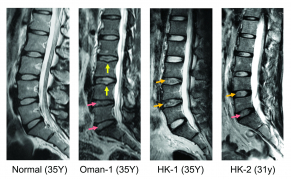 The study result shows that among different populations, LDD cases have been found a genetic variant for an enzyme with them, which is believed to have association with the development of LDD.  In the Hong Kong population, the estimated frequency of the risk variant is 43% for the LDD subjects. The image illustrates the condition of patients with LDD.  